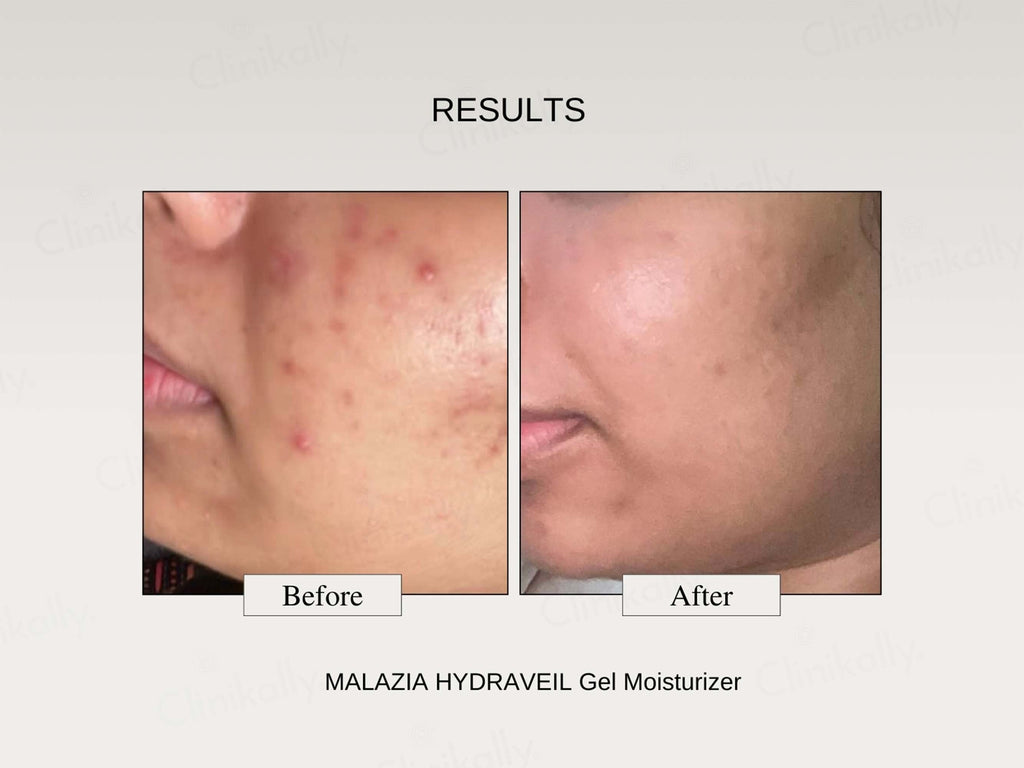 The FormulaRx Malazia Hydra Veil Gel Moisturizer