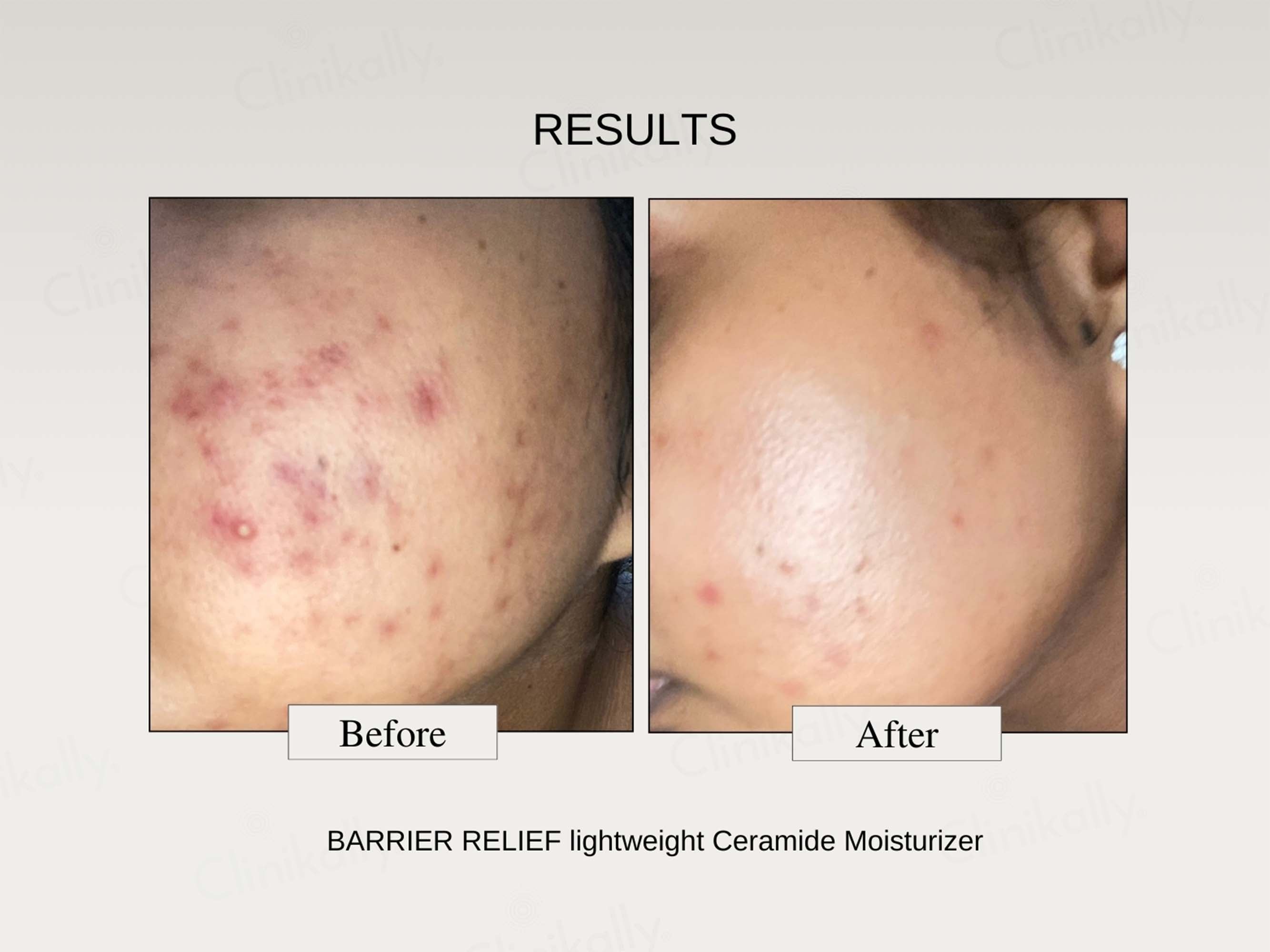 The FormulaRx Barrier Relief Lightweight Ceramide Moisturizer