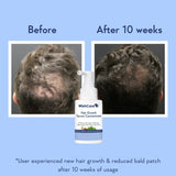 Wishcare Hair Growth Serum Concentrate With 3% Redensyl, 4% Anagain, Rice Water, Biotin