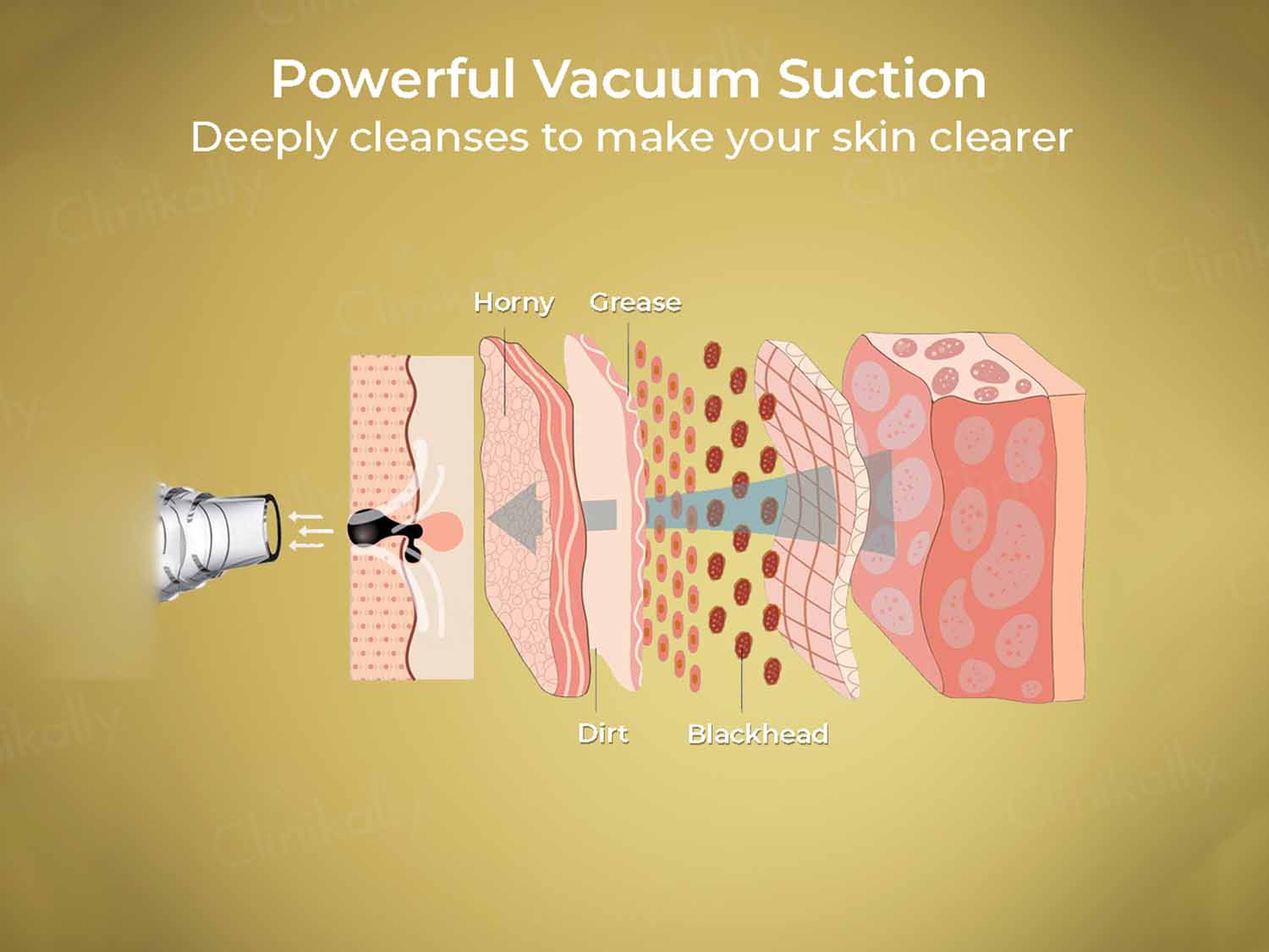 Winston Blackhead Remover