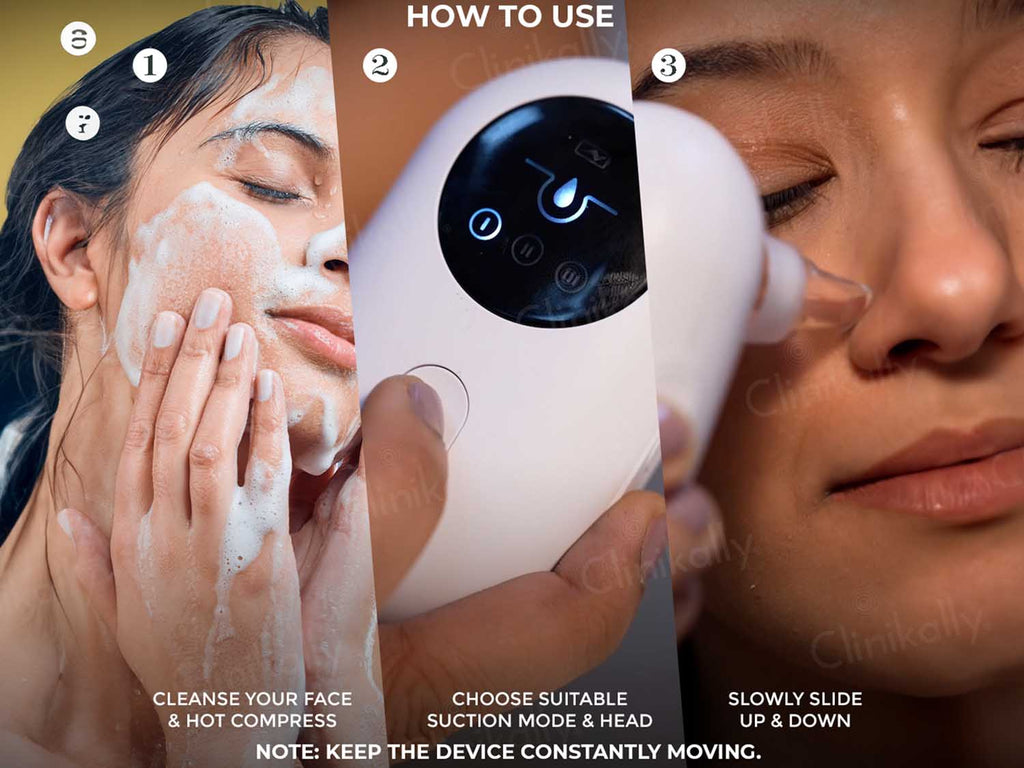 Winston Blackhead Remover