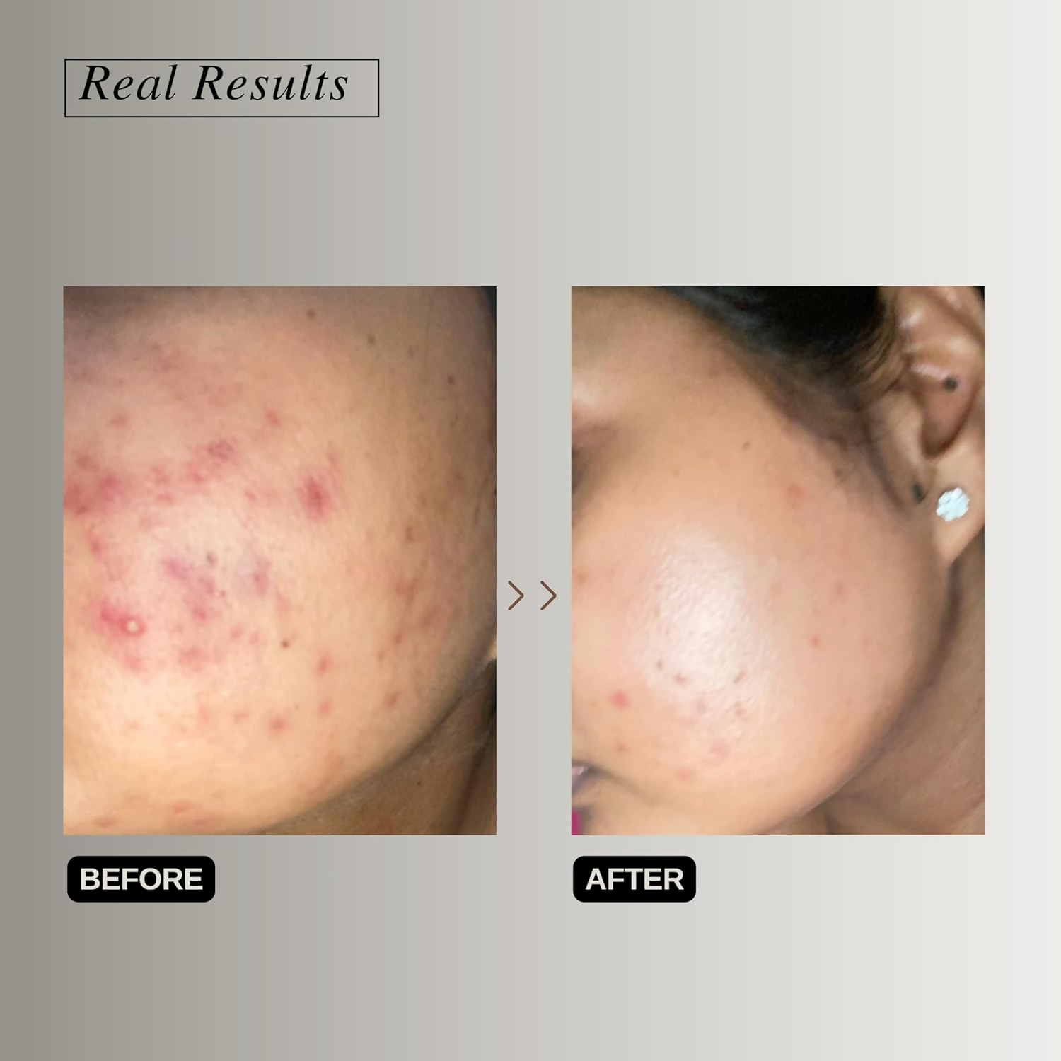 The Formularx Barrier Relief Ceramide Lightweight Moisturizer With Niacinamide & Hyaluronic Acid