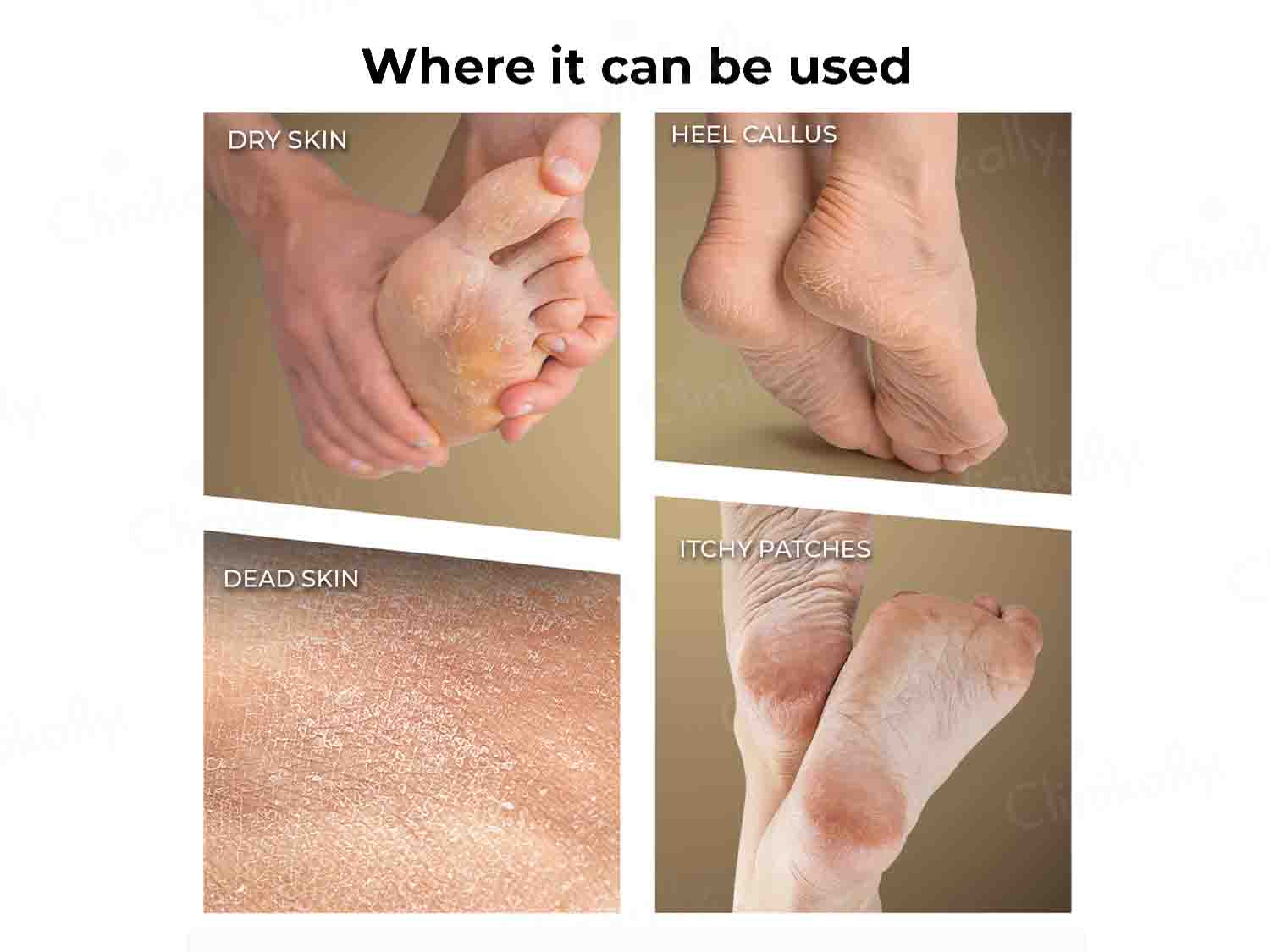 Winston Callus Remover
