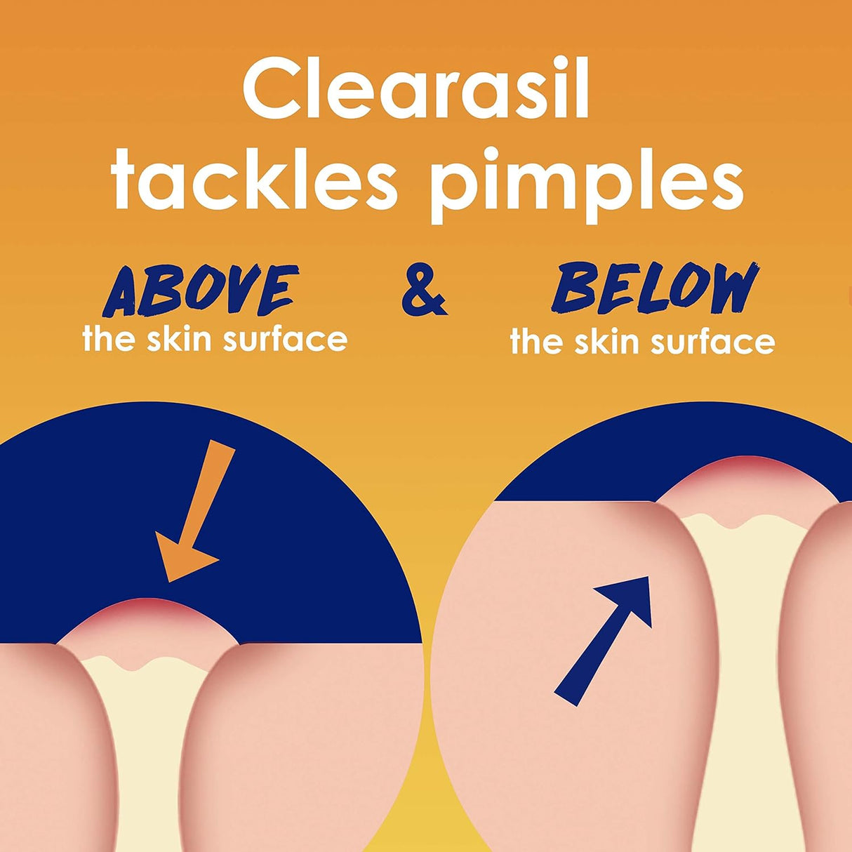 Clearasil Stubborn Acne Control 5in1 Spot Treatment Cream, Maximum Strenght with 10% Benzoyl Peroxide, Acne Medication, 1 oz - Vamzn#